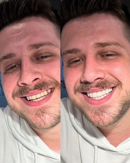 EARLEPS LuxeSmile Biyouyumlu Yeni Nesil Takma Dişler